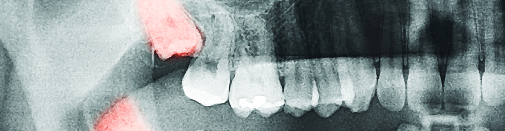 x-ray of impacted wisdom teeth